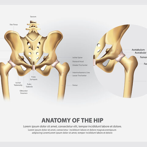 Hip Surgery