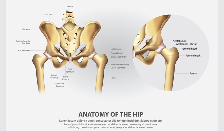 Hip Surgery